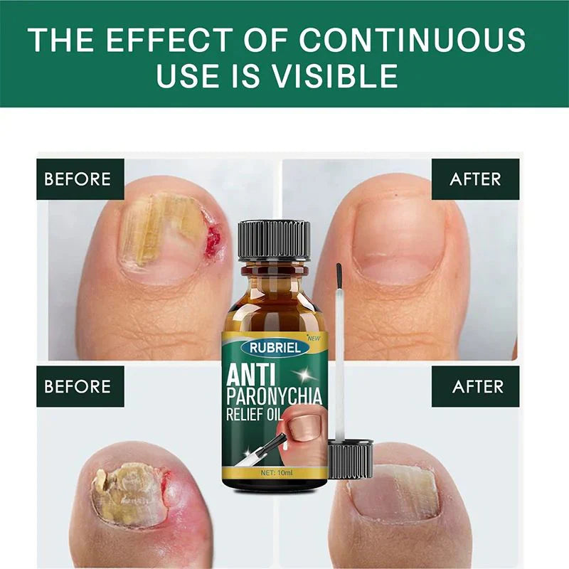 Anti Paronychia Relief Oil- Buy 1 Get 1 Free