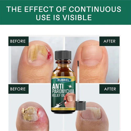 Anti Paronychia Relief Oil- Buy 1 Get 1 Free