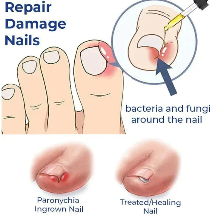 Anti Paronychia Relief Oil- Buy 1 Get 1 Free